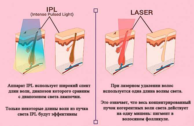 Лазерная эпиляция vs. фотоэпиляция: что лучше?